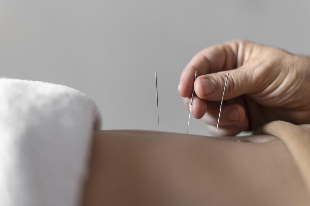 ما هو العلاج بالإبر الصينية؟ دليل شامل لفوائده، أضراره، وعدد الجلسات المطلوبة